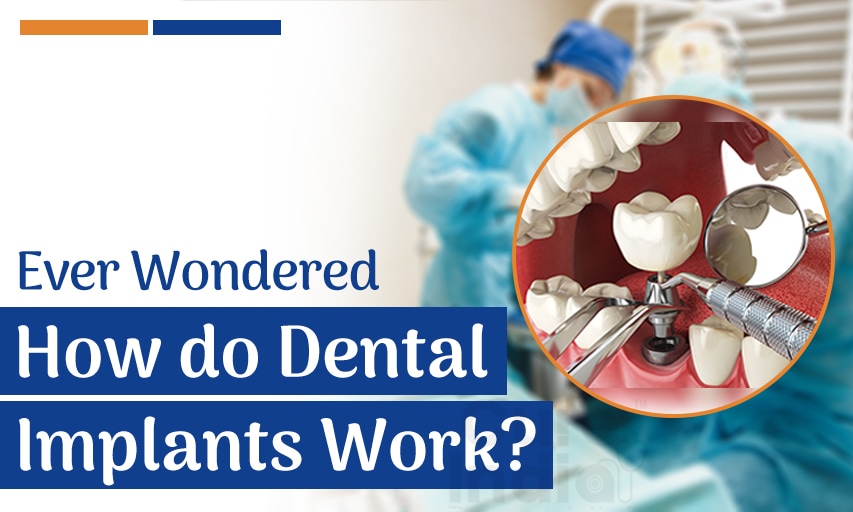 Ever Wondered How Do Dental Implants Work?